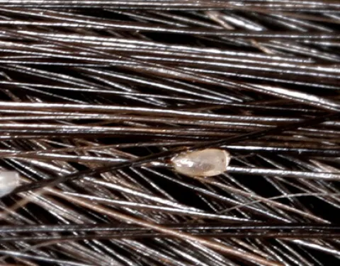 Gnida na włosach zdjęcie