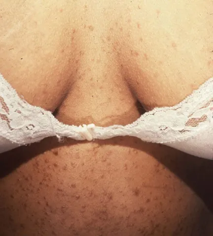 Gruczolaki potowe, syringoma na skórze