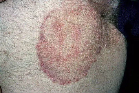 Grzybica fałdów pachwinowych