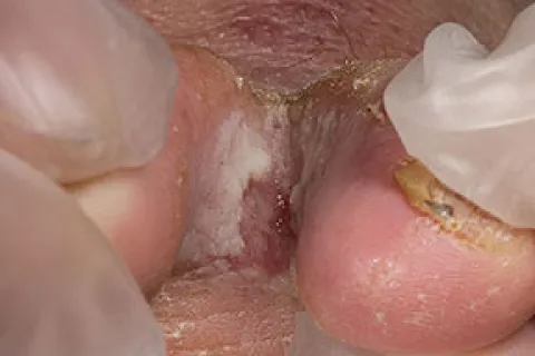 Grzybica między palcami nóg stopa atlety