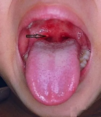 Guzek w gardle 