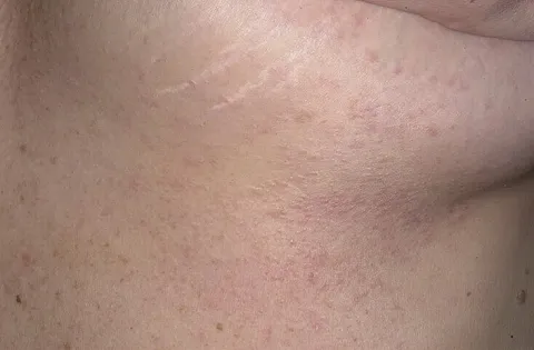 Guzki na skórze pod piersiami syringoma