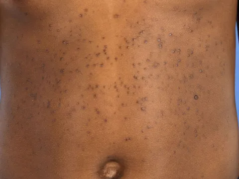 Guzki na skórze syringoma