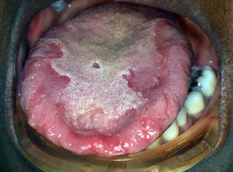 Język geograficzny u dorosłego