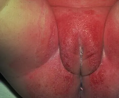  Kandydoza odbytu i narządów płciowych u dziecka