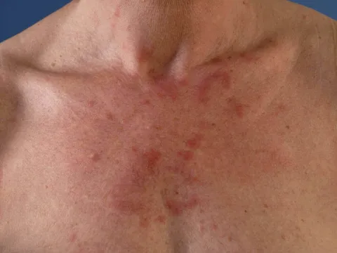 Krostki grudki na skórze uczulenie na słońce