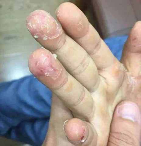 Lateks zmiany skórne na palcach