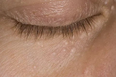 Małe, białe grudki syringoma