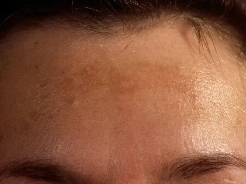 Melasma na czole