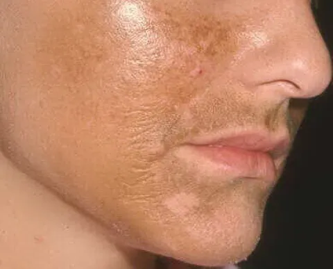 Melasma zdjęcia