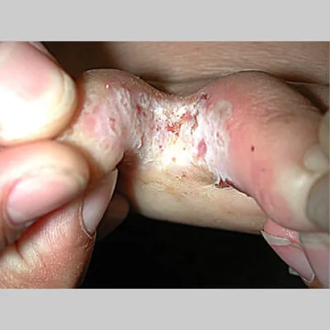 Niegojącą się rana między palcami stopa sportowca 