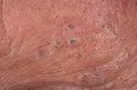 Niepokojące zmiany na skórze zdjęcia wągry