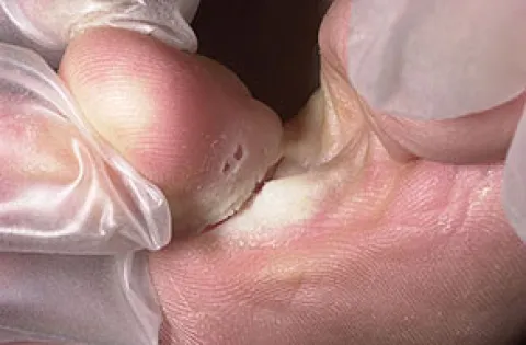 Pękająca skóra między palcami u nóg stopa atlety