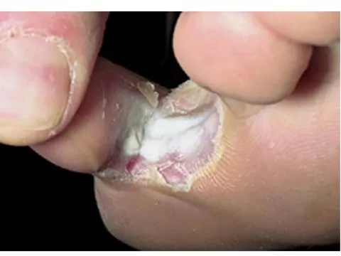 Pęknięcia między palcami u nóg stopa sportowca 