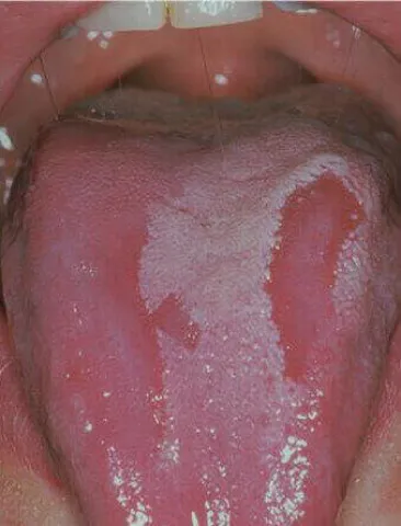 Płaskie plamy na języku