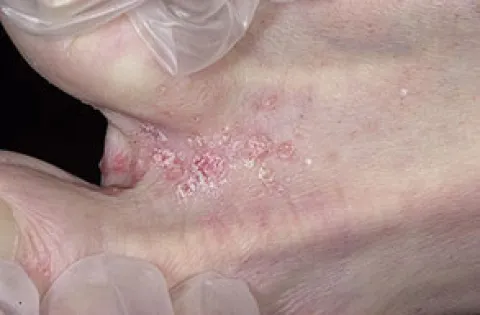 Pierwsze objawy grzybicy na stopach stopa sportowca