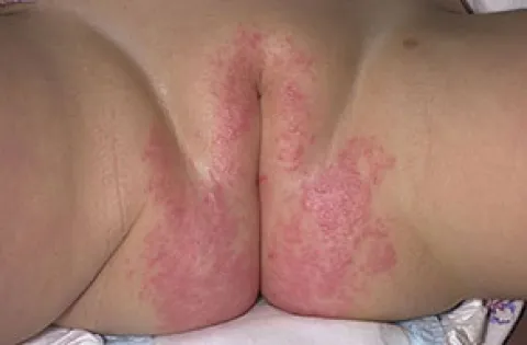 Podrażnienie skóry okolic intymnych u dziecka