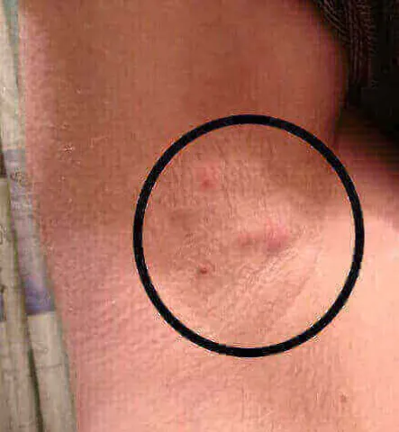 Powiększone węzły chłonne pod pachami u dorosłych