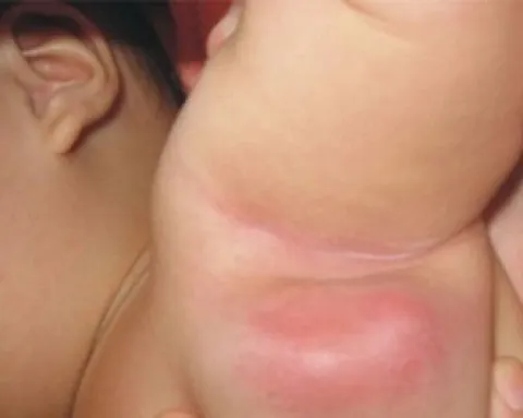 Powiększone węzły chłonne pod pachami u dzieci