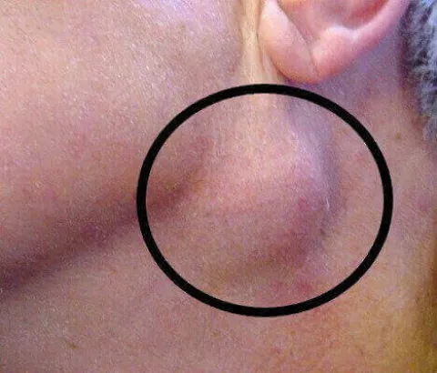 Powiększone węzły chłonne podżuchwowe