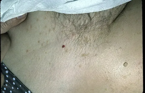 Syringoma miejsce intymne