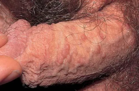 Syringoma na penisie