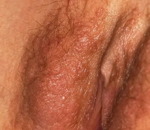 Syringoma warg sromowych