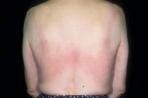 Uczulenie na biustonosz lateksowy