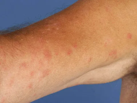 Uczulenie na słońce jak wygląda na ręce