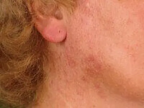 Uczulenie na słońce jak wygląda na twarzy