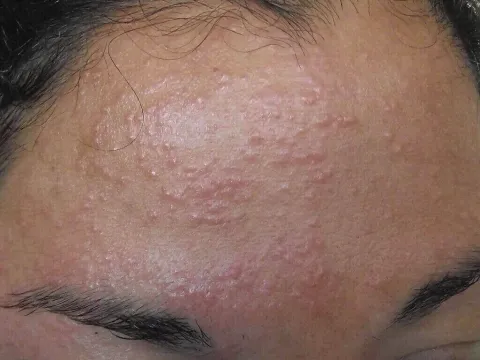 Uczulenie na słońce na czole