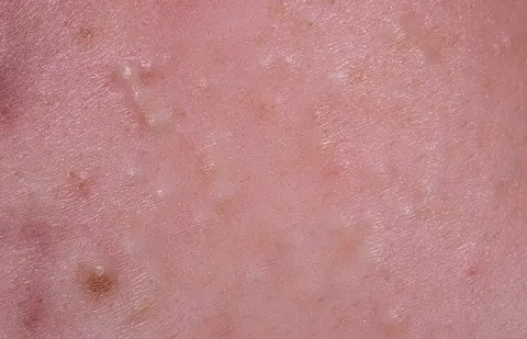 Wągry na skórze zdjęcie