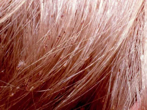 Wszy we włosach