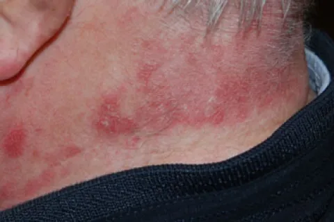 Wysypka na szyi po opalaniu