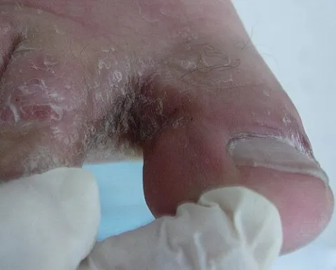 Złuszczający się naskórek na stopie stopa sportowca 