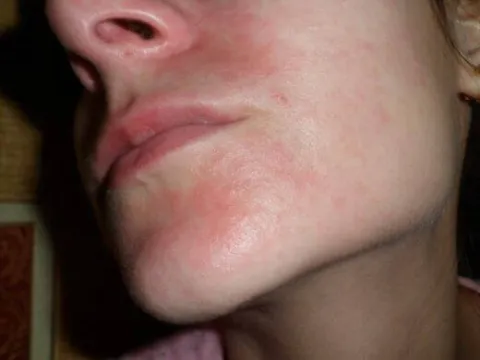 Zaczerwienienie i swędzenie skóry wokół ust