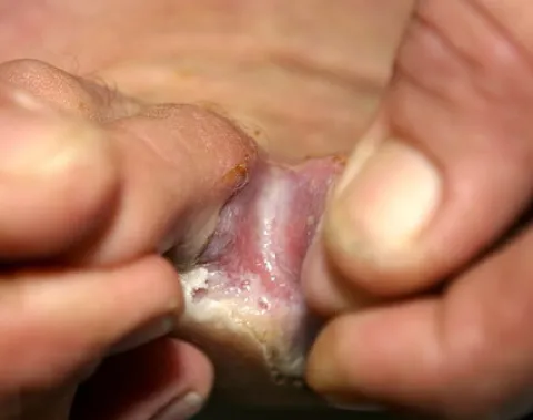 Zaczerwienienie między palcami stopa sportowca 