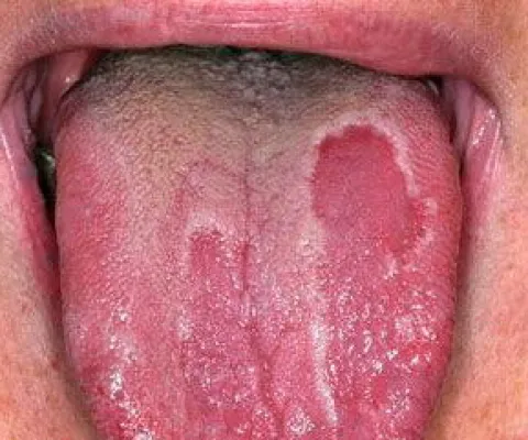 Zaokrąglone plamy na języku