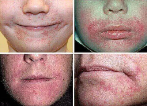 Zapalenie okołoustne objawy