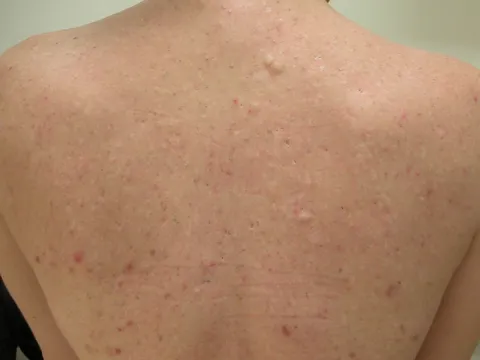 Zaskórniki na plecach od palenia tytoniu