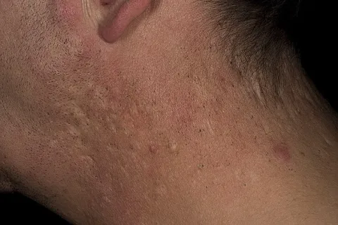 Zaskórniki otwarte broda szyja