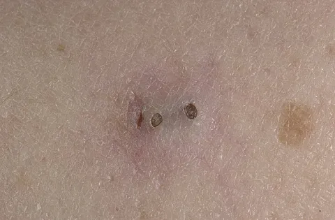 Zaskórniki otwarte na skórze