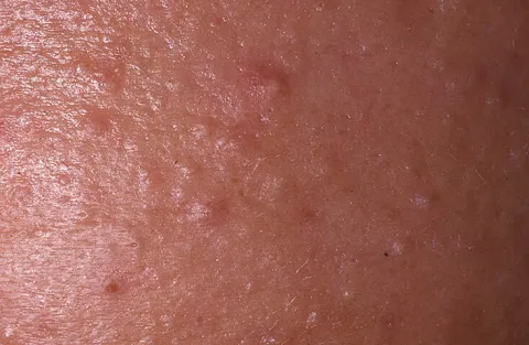 Zaskórniki zamknięte na skórze wygląd