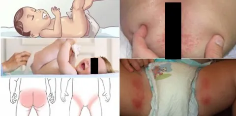 Zdjęcia pieluszkowe zapalenie skóry 
