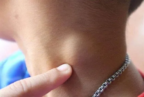 Zdjęcie powiększone węzły chłonne szyi z jednej strony