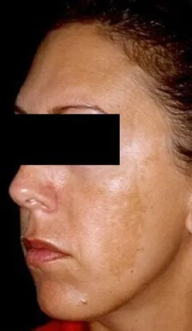 Zmiany skórne w ciąży na twarzy ostuda