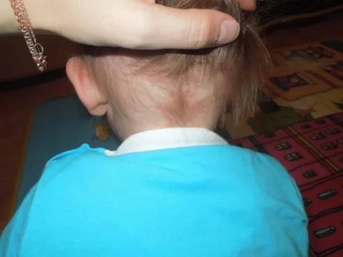 Zmiana skórna na szyi u dziecka uszczypnięcie bociana