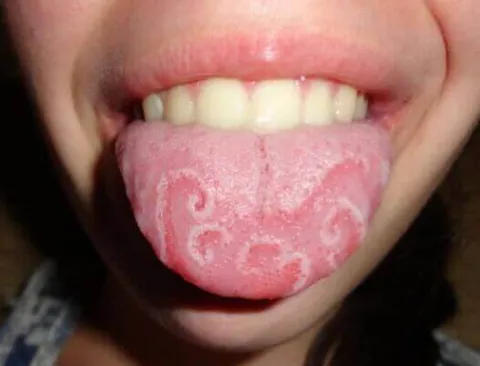 Zmiany na języku u dziecka 