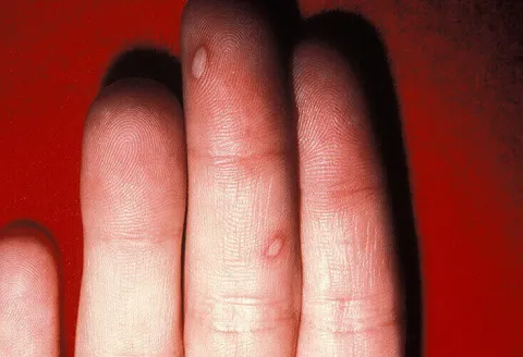 Zmiany skórne na palcach bostonka