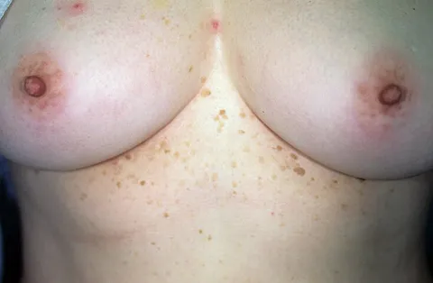 Zmiany skórne pod piersiami zdjęcia brodawki